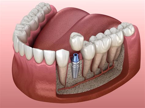 dental implants  option    severe bone loss