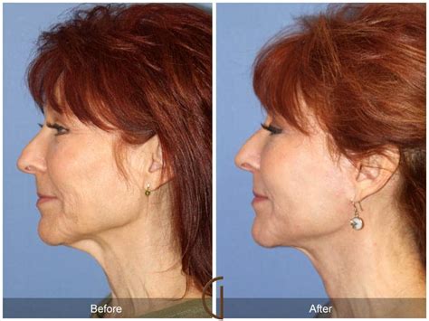 facelift surgery orange county before and after photos
