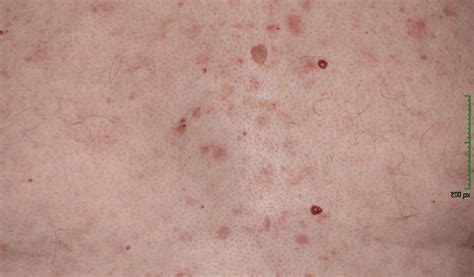 Syphilis Rash Pictures Syphilis Rash The Syphilitic