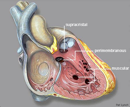 ventricular septal defect vsd learn  heart