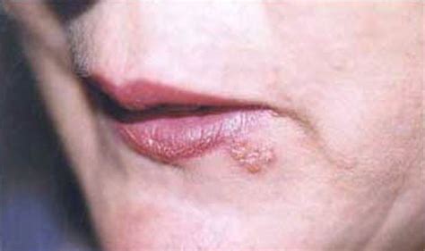 cold sores pictures symptoms treatment  home remedies