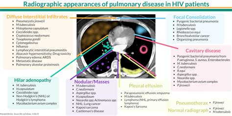 Radiographic Appearances Of Pulmonary Disease In Hiv Infected Grepmed