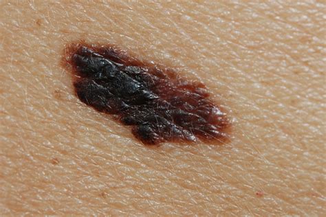 melanoma   skin pictures  clinical information