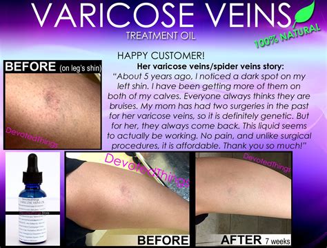 Natural Varicose Vein Treatment And Spider Vein Treatment 2 In 1