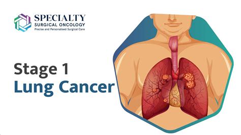 Stage 1 Lung Cancer Signs Symptoms Diagnosis And Treatment