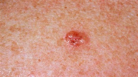 spotting the signs of skin cancer everyday health