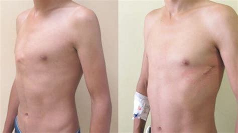pioneering chest deformity op carried out at cardiff hospital bbc news