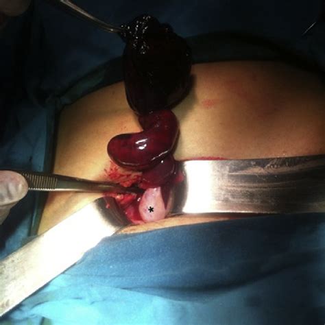 Twisted Fallopian Tube With The Paratubal Cyst And Normal Ovary Case