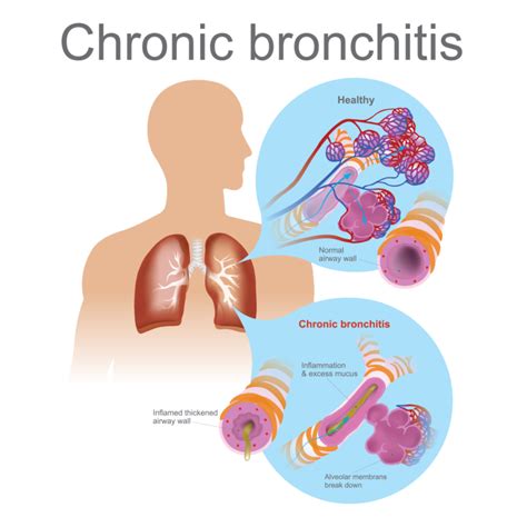 bronchitis acute bronchitis bronchitis symptoms