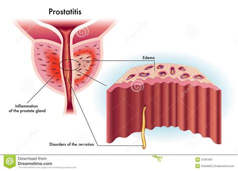 prostatitis stock vector illustration of bacteria prostatitis 37997967