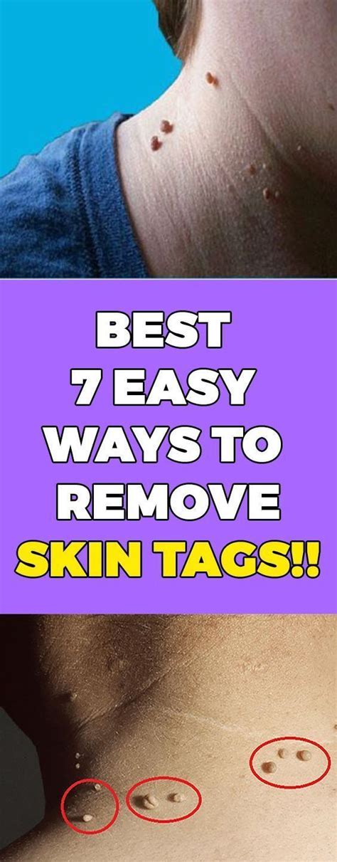 by using natural remedies how we can easily remove skin