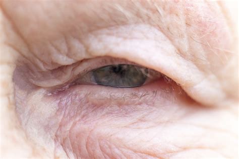 droopy eyelids affect vision eye care  eye news  xxx hot girl