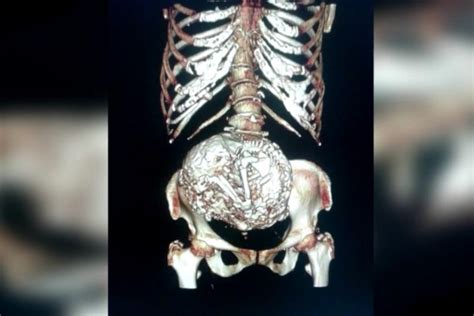 calcified fetus found in 92 year old woman s body