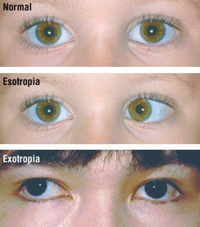 crossed eyes strabismus guide  symptoms  treatment options