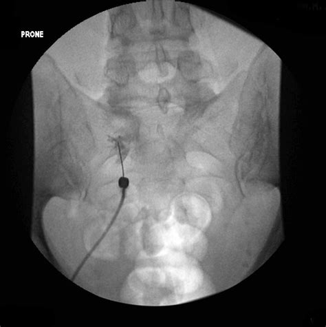 nerve root injection fluoroscopy image radiopaediaorg