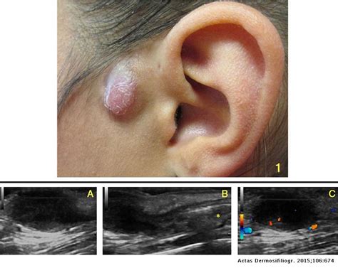 complicated congenital preauricular fistula sonographic features actas dermo sifiliograficas