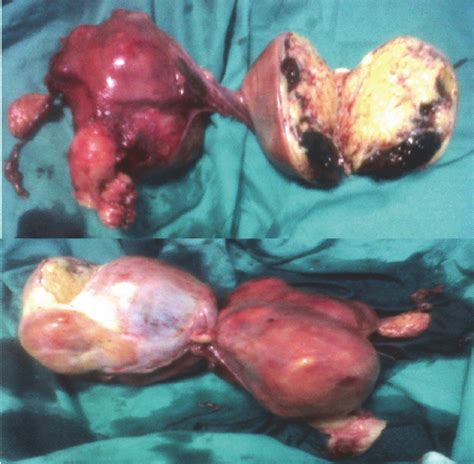 total abdominal hysterectomy and bilateral salpingo