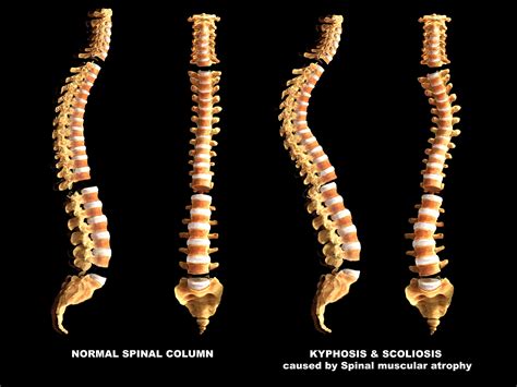 curvatures  vertebral column storymd