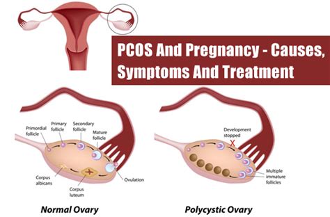 pcos causes symptoms and treatments global treatment services pvt ltd