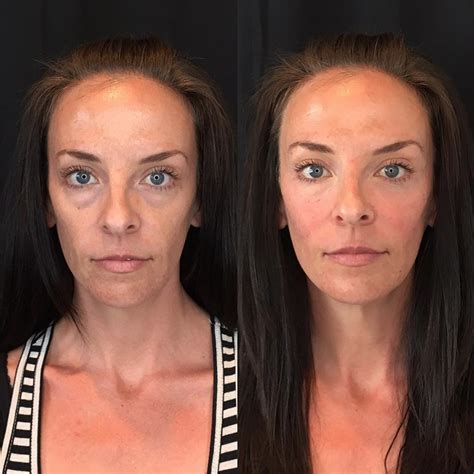 Face And Lip Injection Before After Photos Spa Trouvé In