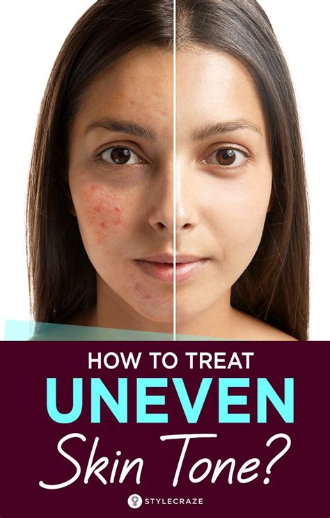uneven skin tone  face  creams  uneven skin tone  india