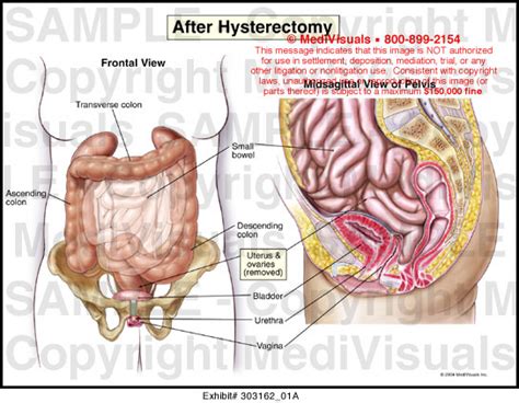 pelvic anatomy after hysterectomy human anatomy