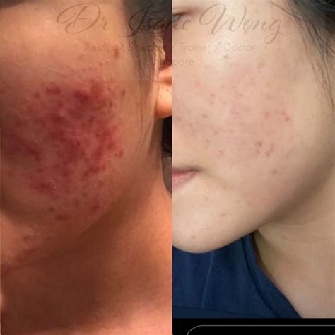 acne scar treatments singapore  acne scar treatments