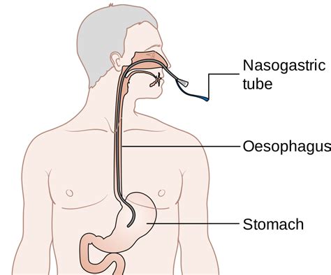 ng tube nasogastric tubes  experience  bad ass