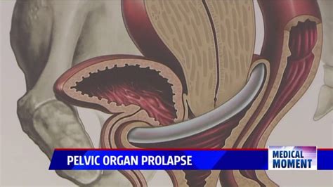 Medical Moment Pelvic Organ Prolapse