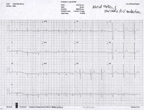 Atrial Flutter Ecg Photograph By Science Source