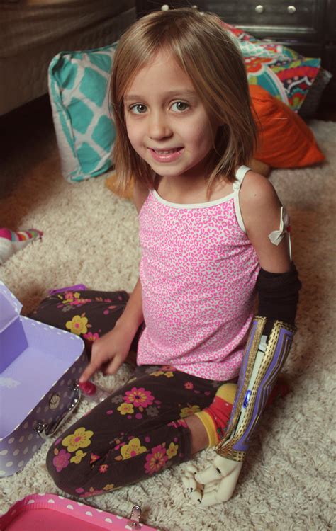 Holiday Miracle 3d Printed Myoelectric Arm Allows Girl Free