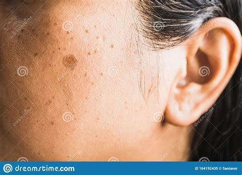 asian woman has a mole stock image image of asian spot 164192435