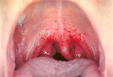 what causes red spot on the roof of your mouth new