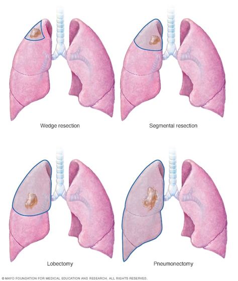 lung cancer surgery mayo clinic