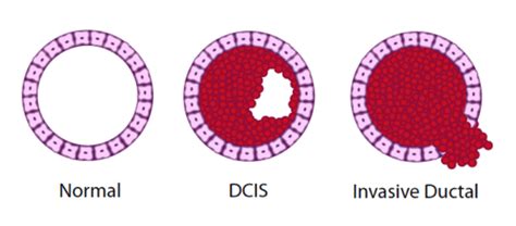 Hormonal Drugs For Dcis Full List 2020