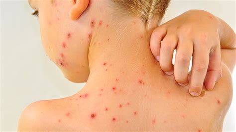 chickenpox outbreak at north carolina school with high anti vaccination