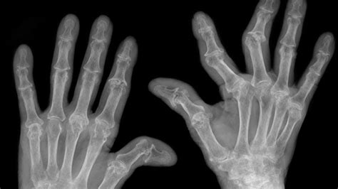Pictures Of Arthritis In Fingers And Knuckles