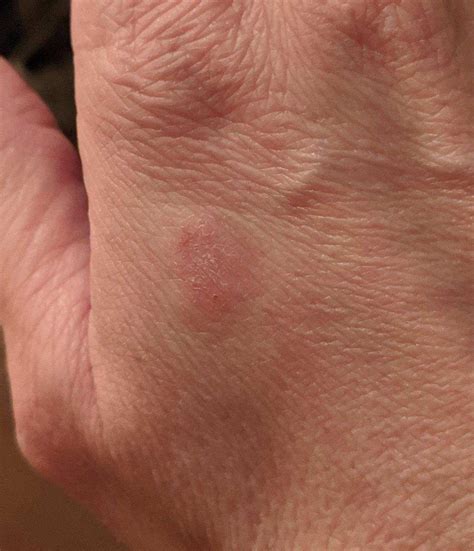 lb small reddish itchy spot  top  hand askdocs