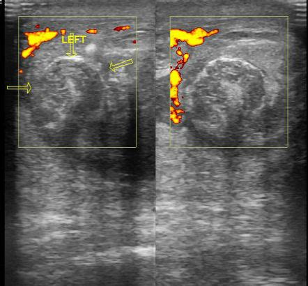 whirlpool sign testicular torsion radiology reference article radiopaediaorg