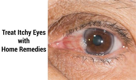 home remedies  itchy eyes top  home remedies