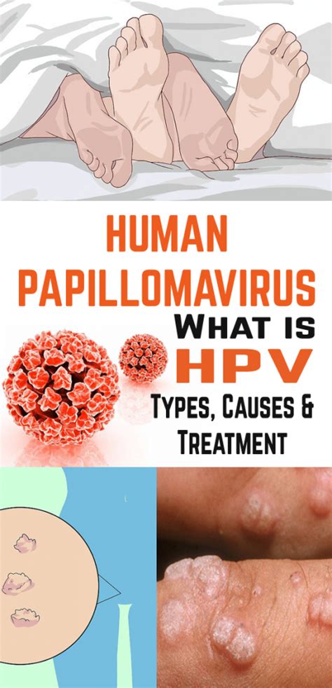 what is hpv from pap smear siawht