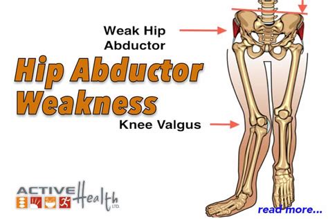 Condition Of The Month Hip Abductor Weakness