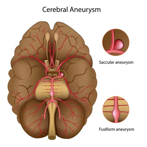 brain aneurysms premier neurology