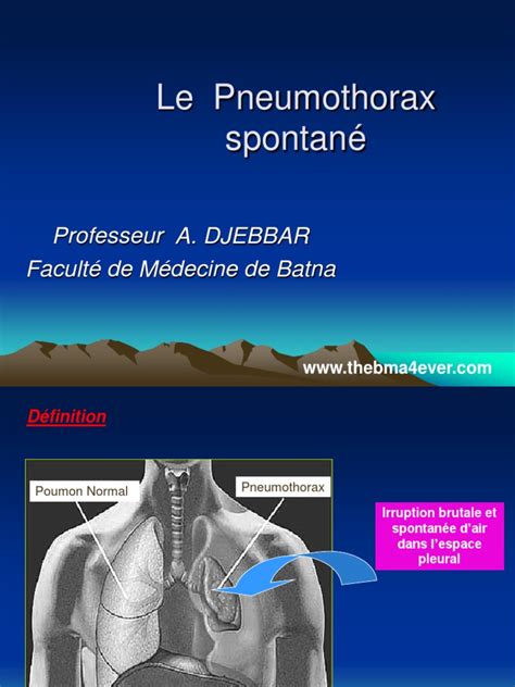 Le Pneumothorax Spontané Ppt Maladies Et Troubles Médecine Clinique