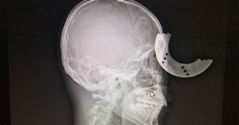 head decorator cheats death  circular blade cuts   skull world news