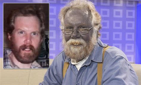 images  people   living   disorder called argyria