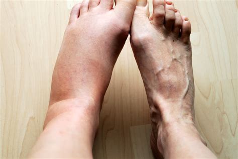 What Causes Ankle And Feet Swelling What Should I Do