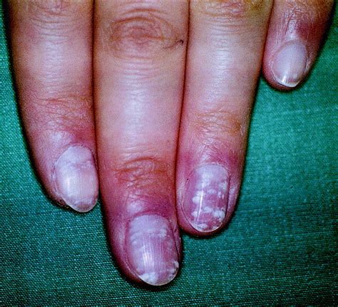 nail disorders in hemodialysis patients and renal transplant recipients