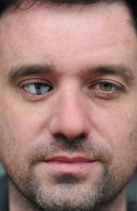 Rob Spence Bionic Eye Toronto Filmmaker Replaces Eyeball With Camera