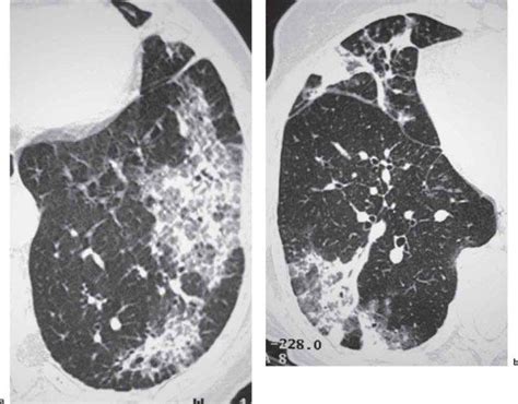 High Resolution Thin Section Ct Patterns In Pulmonary Disease